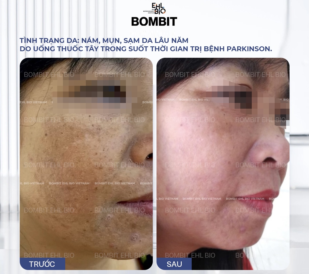 Cách sử dụng méo Exosome