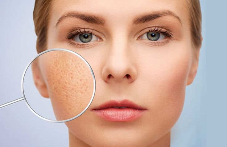 Meso Exsome điều trị sẹo rỗ