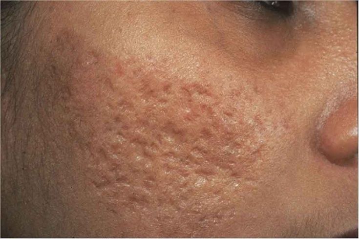 Meso Exsome điều trị sẹo rỗ